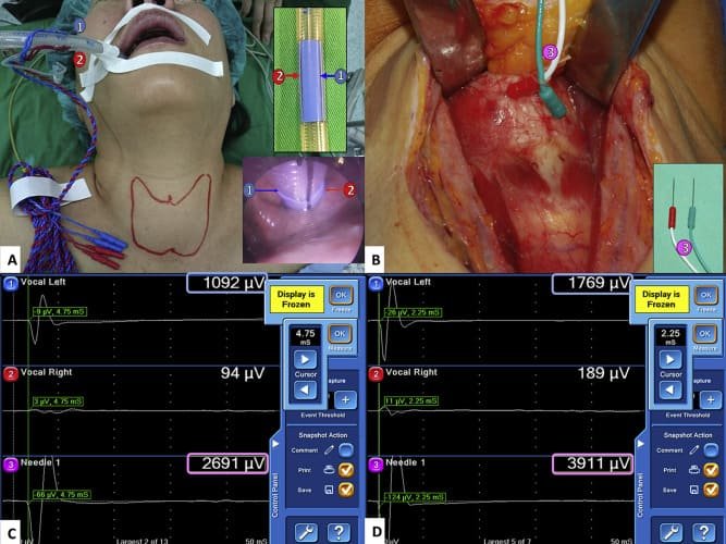 Intraoperative Nerve Monitoring in Thyroid Surgery: A Comprehensive Guide