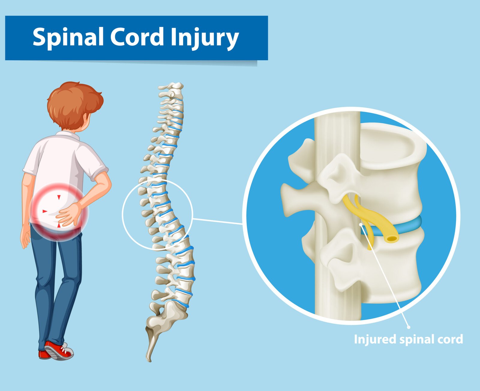 Anesthesia Management for Patients with Spinal Cord Injury (SCI)