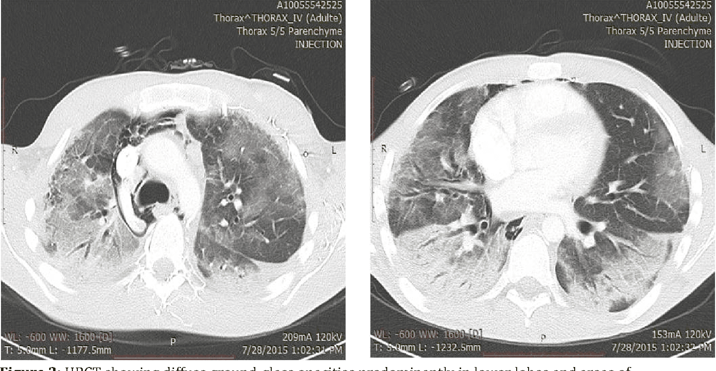 Anesthetic Management for a Patient with Bleomycin-Induced Pulmonary Toxicity Undergoing Laparoscopic Hysterectomy