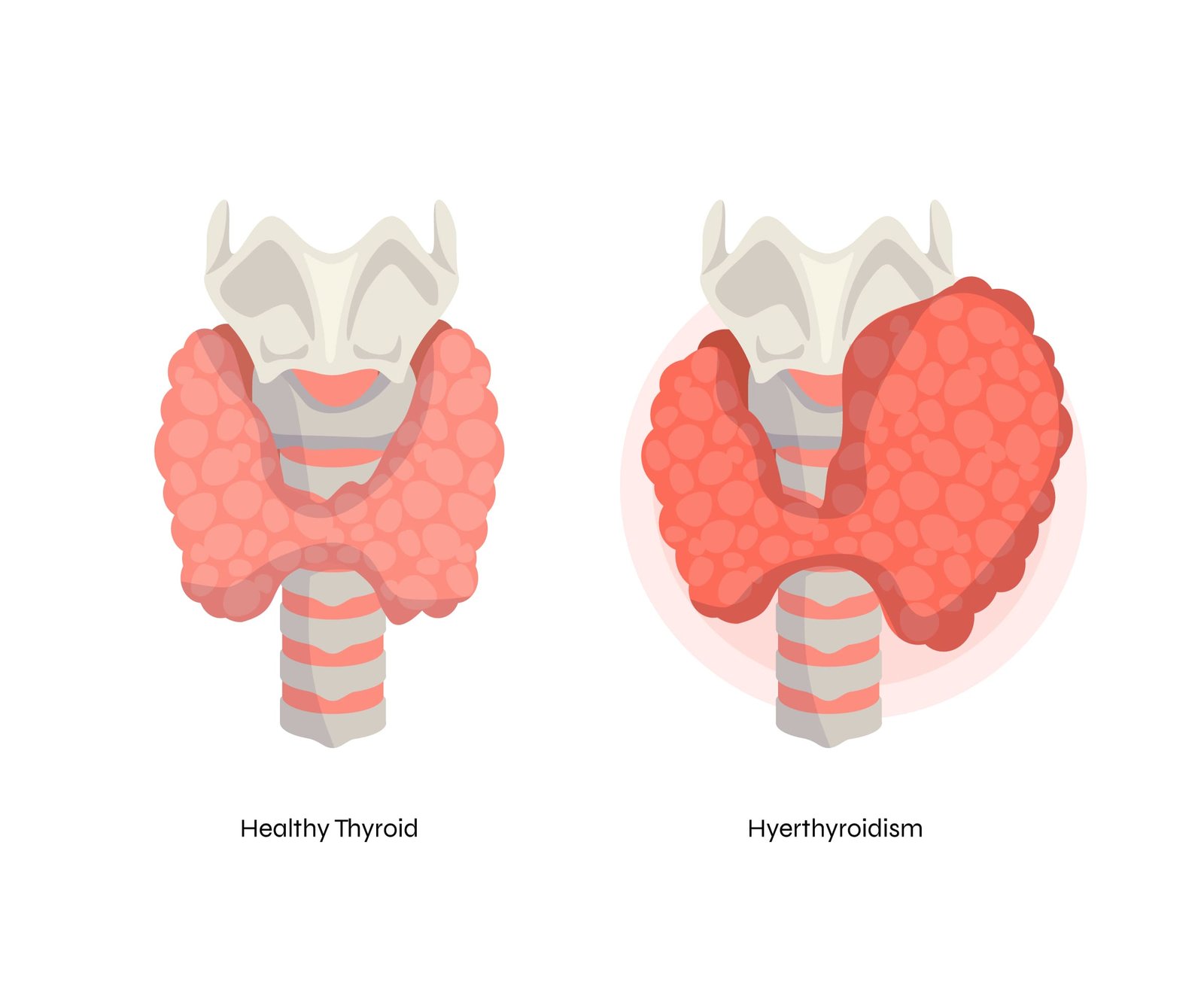 Preoperative Considerations for Patients with Thyroid Disease: 