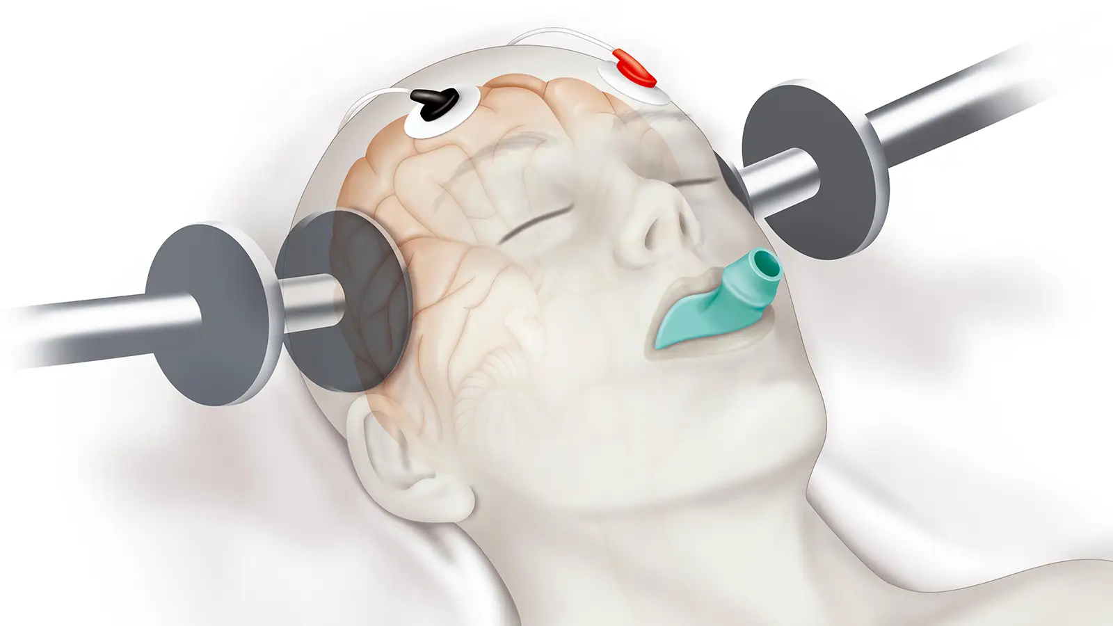 Anesthesia for Electroconvulsive Therapy