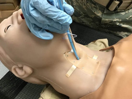 Can’t Intubate, Can’t Ventilate (CICV) Situation Following Airway Hemorrhage
