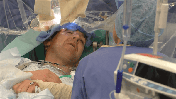 AWAKE CRANIOTOMY